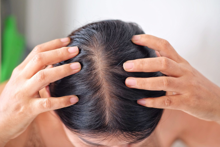 Hair Treatment for Hair Loss: How to Choose Wisely