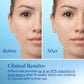 Differin Acne Treatment Gel 30 Day Supply