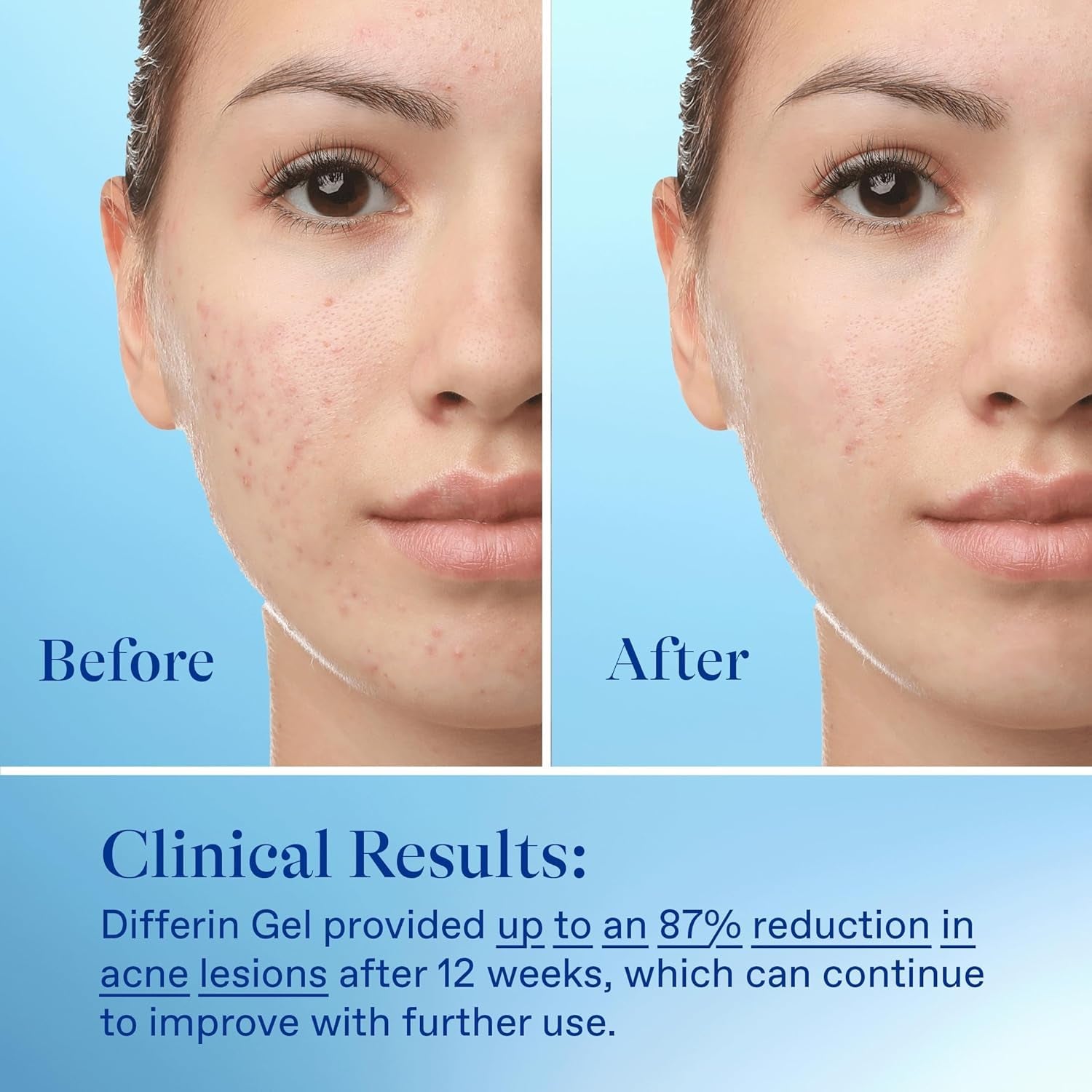 Differin Acne Treatment Gel 30 Day Supply